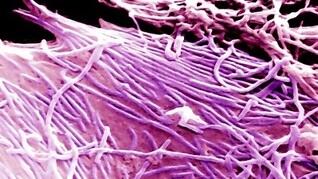Ebola