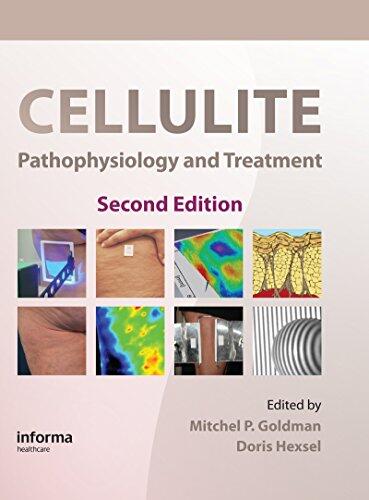 Cellulite: Pathophysiology and Treatment