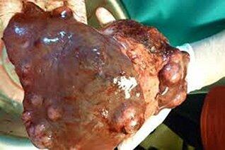 Cancer The BIG C: The Causes And Cures For All Cancers