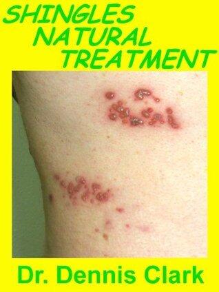 Shingles Natural Treatment
