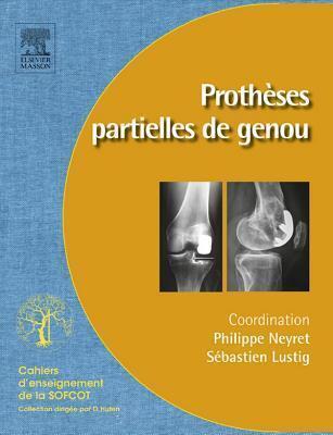 Protheses Partielles Du Genou: Protheses Unicompartimentaires Et Femoropatellaires